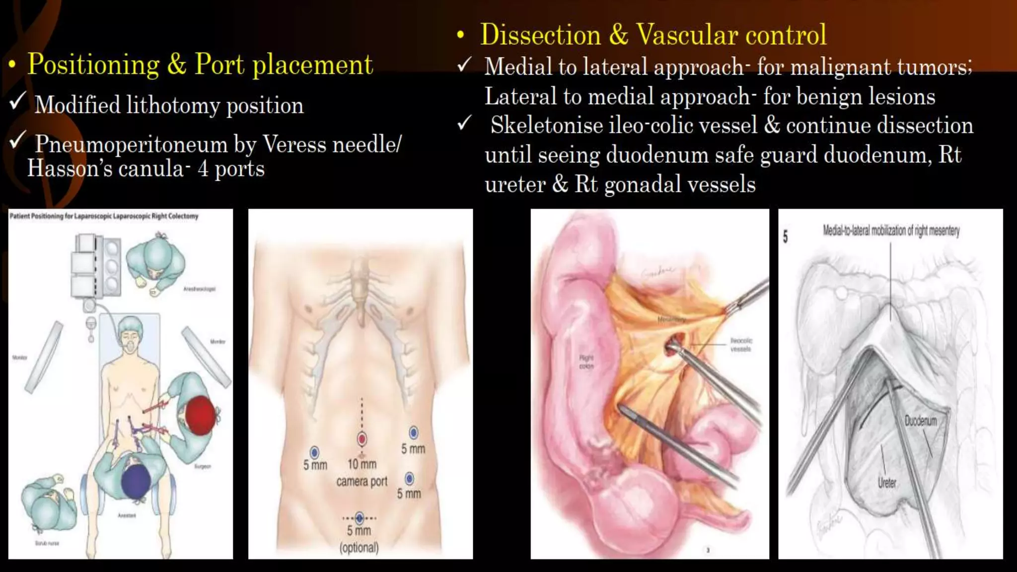 right-hemicolectomy-pptx