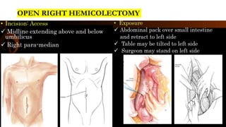 OPEN RIGHT HEMICOLECTOMY
 