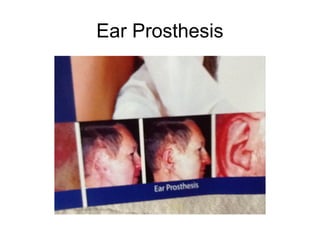 Ear Prosthesis
 