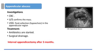 Appendicular abscess
Investigations
• CBC .
• U/S confirms the mass.
• USG: fluid collection (hypoechoic) in the
appendicular region
Treatment:
• Antibiotics are started.
• Surgical drainage.
Interval appendicectomy after 3 months.
USG- Appendicular abscess
 