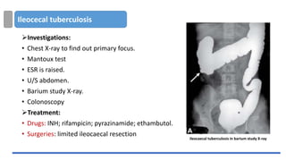 Ileocecal tuberculosis
➢Investigations:
• Chest X-ray to find out primary focus.
• Mantoux test
• ESR is raised.
• U/S abdomen.
• Barium study X-ray.
• Colonoscopy
➢Treatment:
• Drugs: INH; rifampicin; pyrazinamide; ethambutol.
• Surgeries: limited ileocaecal resection
ileocaecal tuberculosis in barium study X-ray
 