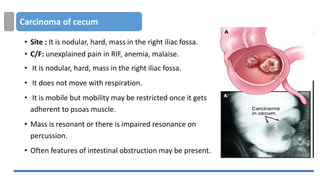 Carcinoma of cecum
• Site : It is nodular, hard, mass in the right iliac fossa.
• C/F: unexplained pain in RIF, anemia, malaise.
• It is nodular, hard, mass in the right iliac fossa.
• It does not move with respiration.
• It is mobile but mobility may be restricted once it gets
adherent to psoas muscle.
• Mass is resonant or there is impaired resonance on
percussion.
• Often features of intestinal obstruction may be present.
 