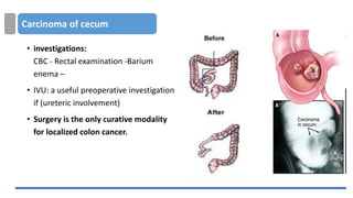 Carcinoma of cecum
• investigations:
CBC - Rectal examination -Barium
enema –
• IVU: a useful preoperative investigation
if (ureteric involvement)
• Surgery is the only curative modality
for localized colon cancer.
 