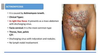 ACTINOMYCOSIS
• It is caused by Actinomyces israelii.
• Clinical Types:
• In right iliac fossa: It presents as a mass abdomen
with discharging sinus.
• Facio-cervical: It is the most common type
• Thorax, liver, pelvic
C/F:
• Discharging sinus with induration and nodules.
• No lymph nodal involvement
 