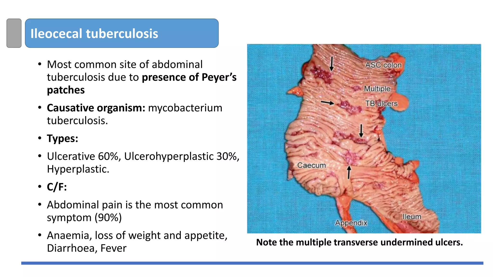 Ileocecal tuberculosis
• Most common site of abdominal
tuberculosis due to presence of Peyer’s
patches
• Causative organism: mycobacterium
tuberculosis.
• Types:
• Ulcerative 60%, Ulcerohyperplastic 30%,
Hyperplastic.
• C/F:
• Abdominal pain is the most common
symptom (90%)
• Anaemia, loss of weight and appetite,
Diarrhoea, Fever
Note the multiple transverse undermined ulcers.
 