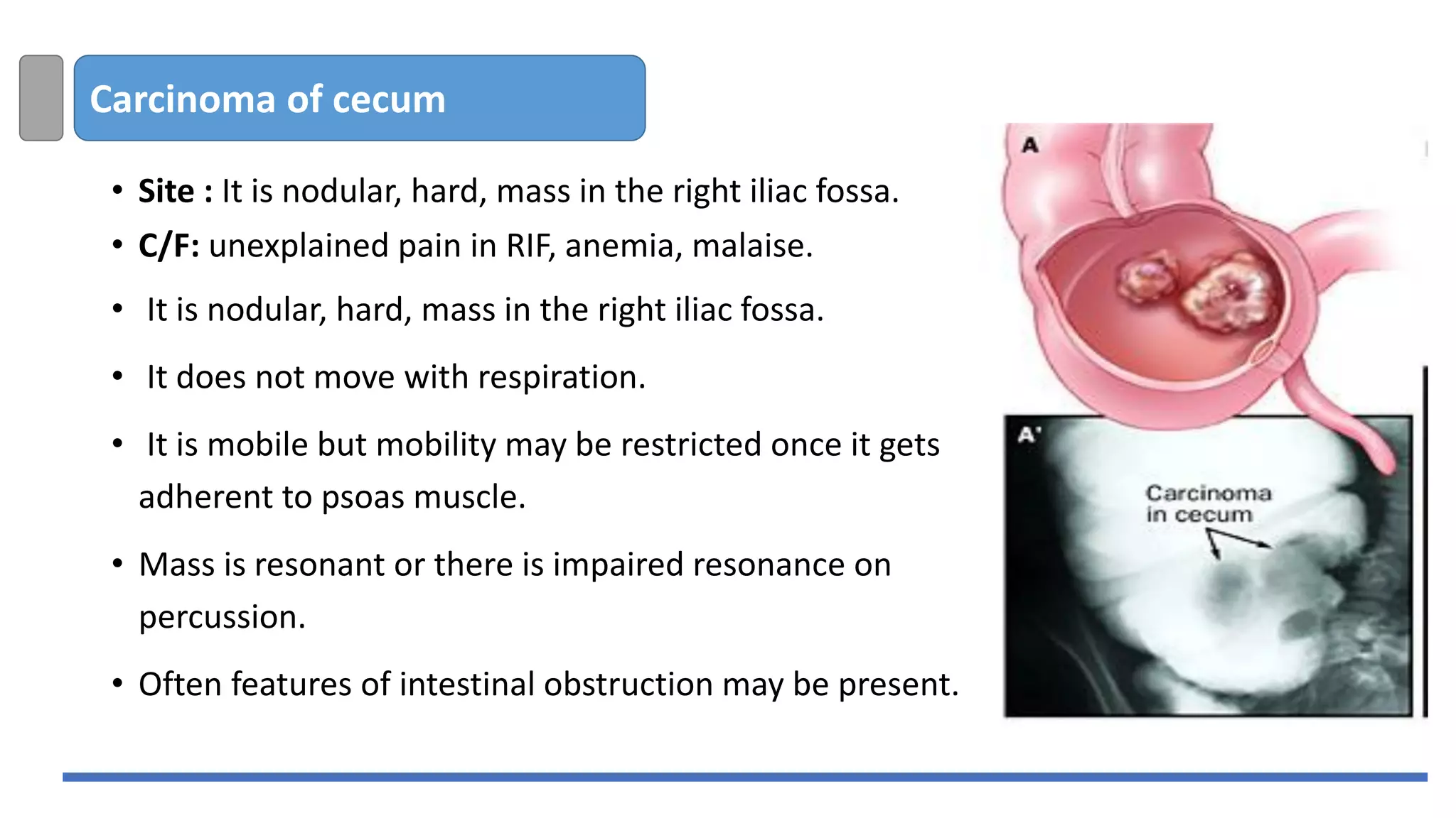 Carcinoma of cecum
• Site : It is nodular, hard, mass in the right iliac fossa.
• C/F: unexplained pain in RIF, anemia, malaise.
• It is nodular, hard, mass in the right iliac fossa.
• It does not move with respiration.
• It is mobile but mobility may be restricted once it gets
adherent to psoas muscle.
• Mass is resonant or there is impaired resonance on
percussion.
• Often features of intestinal obstruction may be present.
 