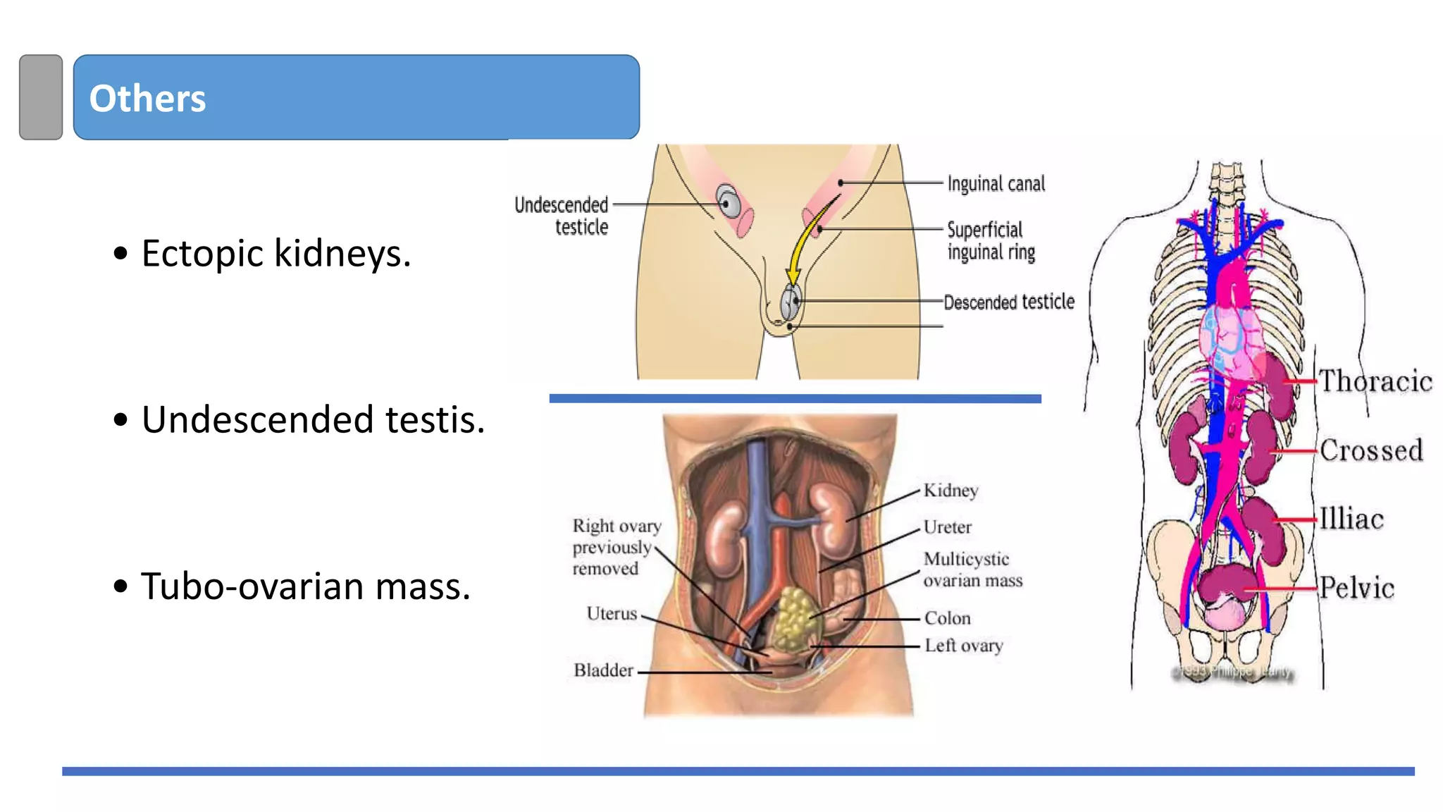 Others
• Ectopic kidneys.
• Undescended testis.
• Tubo-ovarian mass.
 