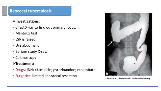 Right iliac fossa mass