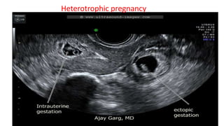 Heterotrophic pregnancy
 