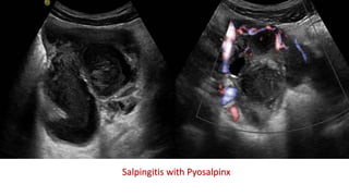 Salpingitis with Pyosalpinx
 