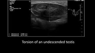 Torsion of an undescended testis
 