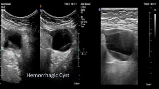 Hemorrhagic Cyst
 