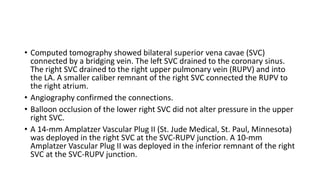 • Computed tomography showed bilateral superior vena cavae (SVC)
connected by a bridging vein. The left SVC drained to the coronary sinus.
The right SVC drained to the right upper pulmonary vein (RUPV) and into
the LA. A smaller caliber remnant of the right SVC connected the RUPV to
the right atrium.
• Angiography confirmed the connections.
• Balloon occlusion of the lower right SVC did not alter pressure in the upper
right SVC.
• A 14-mm Amplatzer Vascular Plug II (St. Jude Medical, St. Paul, Minnesota)
was deployed in the right SVC at the SVC-RUPV junction. A 10-mm
Amplatzer Vascular Plug II was deployed in the inferior remnant of the right
SVC at the SVC-RUPV junction.
 