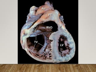 Ventricular Rhy Right Ventricle Anatomy, Physiology & ECHO Assessment by Dr. Vaibhav ...