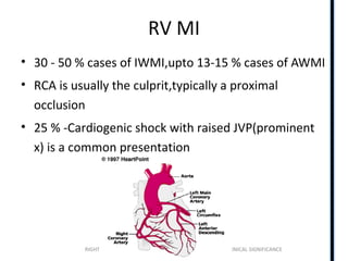 RIGHT VENTRICLE ANATOMY,PHYSIOLOGY, ASSESSMENT & CLINICAL SIGNIFICANCE
RV MI
• 30 - 50 % cases of IWMI,upto 13-15 % cases of AWMI
• RCA is usually the culprit,typically a proximal
occlusion
• 25 % -Cardiogenic shock with raised JVP(prominent
x) is a common presentation
 