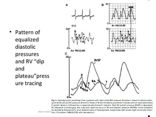 RIGHT VENTRICLE ANATOMY,PHYSIOLOGY, ASSESSMENT & CLINICAL SIGNIFICANCE
• Pattern of
equalized
diastolic
pressures
and RV “dip
and
plateau”press
ure tracing
 