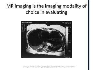 RIGHT VENTRICLE ANATOMY,PHYSIOLOGY, ASSESSMENT & CLINICAL SIGNIFICANCE
MR imaging is the imaging modality of
choice in evaluating
 