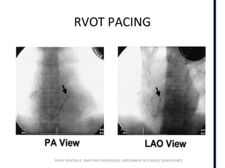 RIGHT VENTRICLE ANATOMY,PHYSIOLOGY, ASSESSMENT & CLINICAL SIGNIFICANCE
RVOT PACING
 