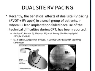 RIGHT VENTRICLE ANATOMY,PHYSIOLOGY, ASSESSMENT & CLINICAL SIGNIFICANCE
DUAL SITE RV PACING
• Recently, the beneficial effects of dual site RV pacing
(RVOT + RV apex) in a small group of patients, in
whom CS lead implantation failed because of the
technical difficulties during CRT, has been reported.
– Pachon JC, Pachon EI, Albornoz RN, et al. Pacing Clin Electrophysiol
2001;24:1369e76.
– O Sai Satish ,Europace et al (2005) 7, 380e384,The European Society of
Cardiology.
 