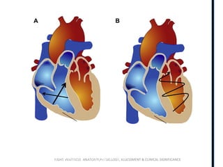 RIGHT VENTRICLE ANATOMY,PHYSIOLOGY, ASSESSMENT & CLINICAL SIGNIFICANCE
Higher ratio of RV volume change to RV free wall surface area change and
allows the RV to eject a large volume of blood with little alteration in RV
wall stretch.
Poorly adapted to generating high pressure.
 