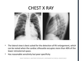 RIGHT VENTRICLE ANATOMY,PHYSIOLOGY, ASSESSMENT & CLINICAL SIGNIFICANCE
CHEST X RAY
• The lateral view is best suited for the detection of RV enlargement, which
can be noted when the cardiac silhouette occupies more than 40% of the
lower retrosternal space.
• Has reasonable sensitivity but poor specificity
 