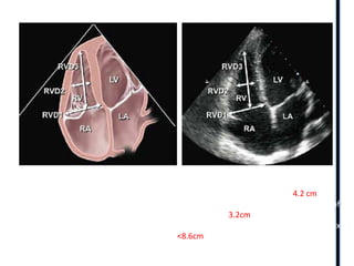 The basal diameter is the maximal short-axis dimension in the basal
one third of the RV . The upper reference limit for the RV basal dimension is 4.2 cm
The midcavity diameter is measured in the middle third of the right ventricle at the level of
the RV papillary muscles. Normal <3.2cm
The longitudinal dimension is drawn from the plane of the tricuspid annulus to the RV apex
Normal<8.6cm
 