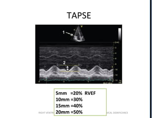 RIGHT VENTRICLE ANATOMY,PHYSIOLOGY, ASSESSMENT & CLINICAL SIGNIFICANCE
TAPSE
5mm =20% RVEF
10mm =30%
15mm =40%
20mm =50%
 