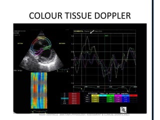 RIGHT VENTRICLE ANATOMY,PHYSIOLOGY, ASSESSMENT & CLINICAL SIGNIFICANCE
COLOUR TISSUE DOPPLER
 