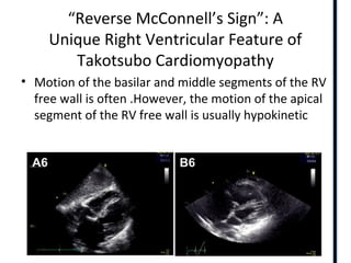 RIGHT VENTRICLE ANATOMY,PHYSIOLOGY, ASSESSMENT & CLINICAL SIGNIFICANCE
“Reverse McConnell’s Sign”: A
Unique Right Ventricular Feature of
Takotsubo Cardiomyopathy
• Motion of the basilar and middle segments of the RV
free wall is often .However, the motion of the apical
segment of the RV free wall is usually hypokinetic
 