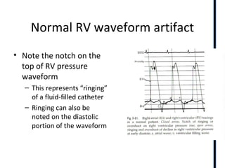 Normal RV waveform artifact
• Note the notch on the
top of RV pressure
waveform
– This represents “ringing”
of a fluid-filled catheter
– Ringing can also be
noted on the diastolic
portion of the waveform
 