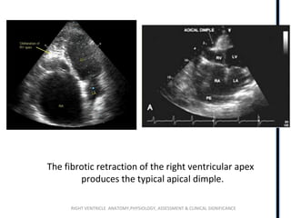 RIGHT VENTRICLE ANATOMY,PHYSIOLOGY, ASSESSMENT & CLINICAL SIGNIFICANCE
The fibrotic retraction of the right ventricular apex
produces the typical apical dimple.
 