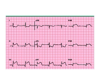 Right ventricle infarction | PPTX