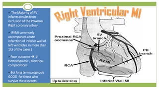  The Majority of RV
infarcts results from
occlusion of the Proximal
Right coronary artery
 RVMI commonly
accompanies acute
infarction of inferior wall of
left ventricle ( in more than
13 of the cases )
Poor outcome  1-
Hemodynamic , electrical
complications
But long term prognosis
GOOD for those who
survive these events Up to date 2019
 