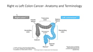 Right vs Left Sidedness in Colon Cancer.pptx