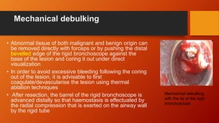 Mechanical debulking
• Abnormal tissue of both malignant and benign origin can
be removed directly with forceps or by pushing the distal
bevelled edge of the rigid bronchoscope against the
base of the lesion and coring it out under direct
visualization
• In order to avoid excessive bleeding following the coring
out of the lesion, it is advisable to first
coagulate/devascularise the lesion using thermal
ablation techniques
• After resection, the barrel of the rigid bronchoscope is
advanced distally so that haemostasis is effectuated by
the radial compression that is exerted on the airway wall
by the rigid tube
Mechanical debulking
with the tip of the rigid
bronchoscope
 