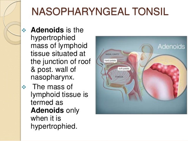 Ring Of Lymphoid Tissue In Mouth Ring Of Lymphoid Tissue In Mouth