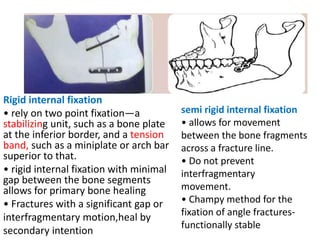 Semi Rigid Fixation Examples RIGID INTERNAL.pptx