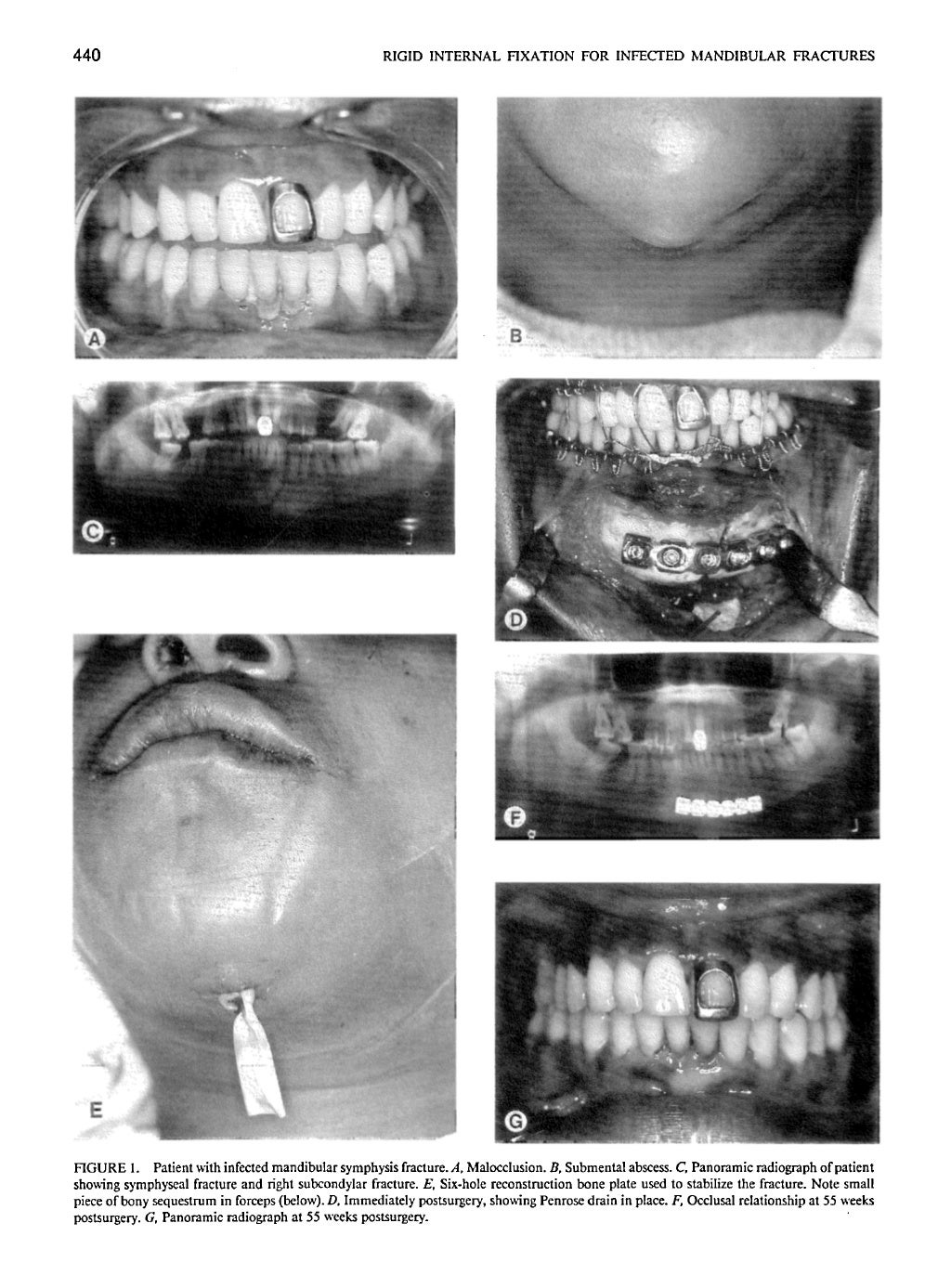 Rigid internal fixation for mandibular of infected mandibular fractur…