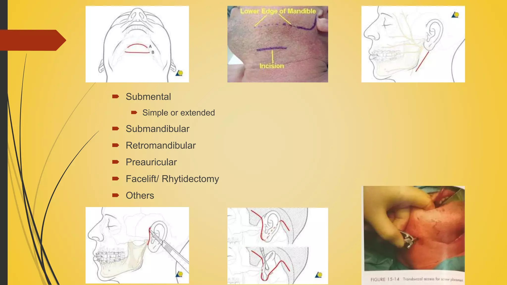  Submental
 Simple or extended
 Submandibular
 Retromandibular
 Preauricular
 Facelift/ Rhytidectomy
 Others
 