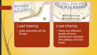 Load bearing
• plate assumes all the
forces
Load sharing
• there are different
levels of force
distribution between
the plate(s) and the
bone
 
