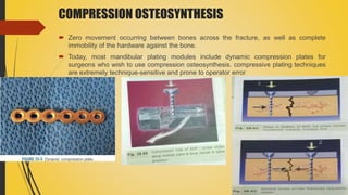 COMPRESSION OSTEOSYNTHESIS
 Zero movement occurring between bones across the fracture, as well as complete
immobility of the hardware against the bone.
 Today, most mandibular plating modules include dynamic compression plates for
surgeons who wish to use compression osteosynthesis. compressive plating techniques
are extremely technique-sensitive and prone to operator error
 