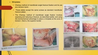  Miniplates
 Champy method of mandibular angle fracture fixation and its use
as a tension band..
 These plates accept the same screws as standard mandibular
fracture plates
 The Champy method of mandibular angle fixation involves
exposing and reducing a fracture, as described earlier, and using
the biomechanical advantage to place a miniplate at the zone of
tension—that is, the superior border
 