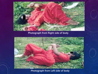 Photograph from Right side of body
Photograph from Left side of body
 