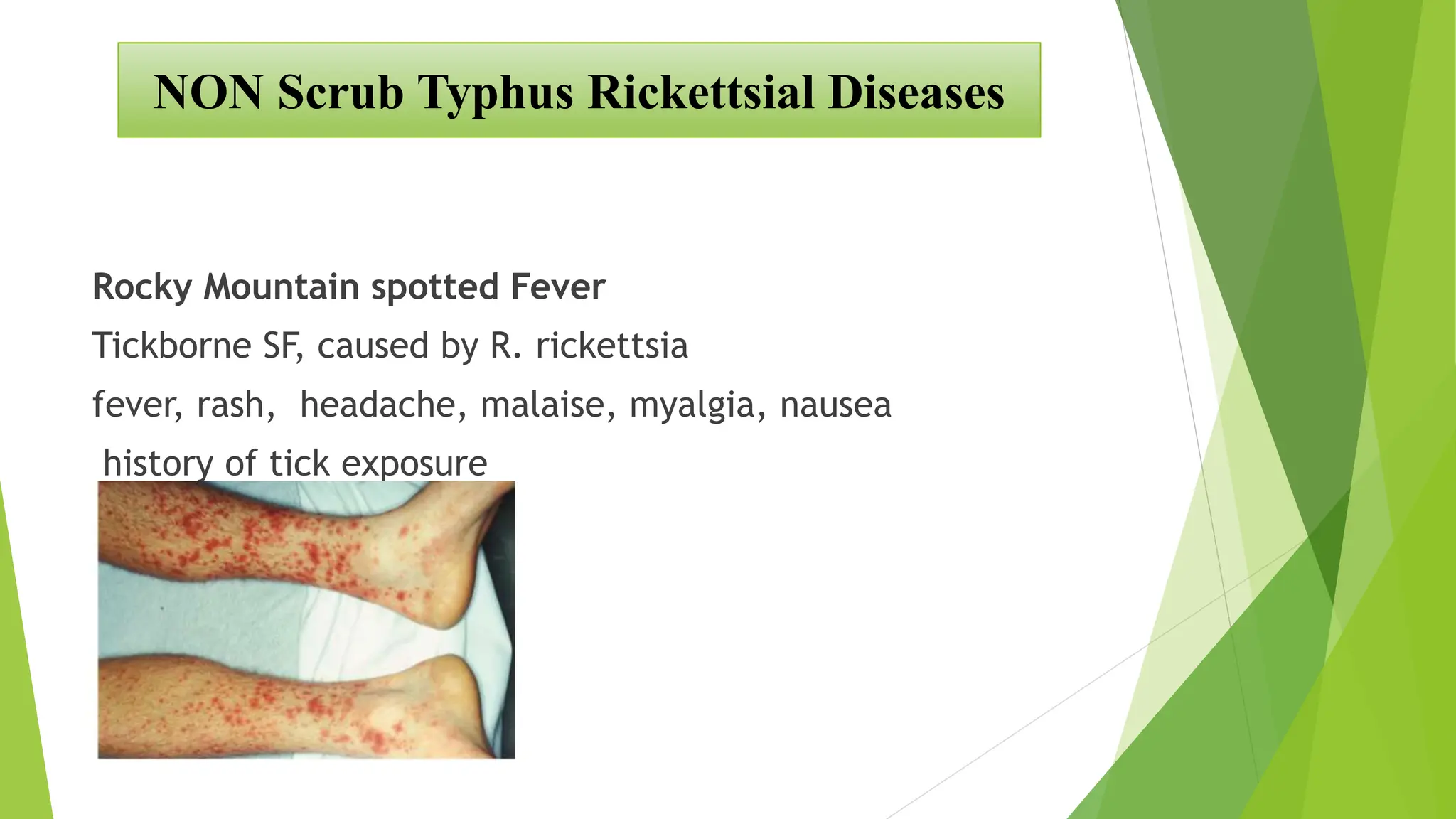 RIKETTSIAL DISEASE IN INDIA [Autosaved].pptx