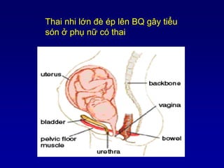 Thai nhi lớn đè ép lên BQ gây tiểu
són ở phụ nữ có thai
 