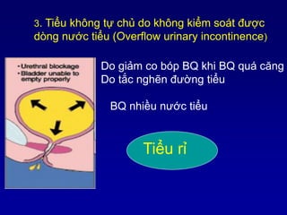 3. Tiểu không tự chủ do không kiểm soát được
dòng nước tiểu (Overflow urinary incontinence)
Do giảm co bóp BQ khi BQ quá c...