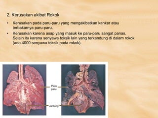 2. Kerusakan akibat Rokok
• Kerusakan pada paru-paru yang mengakibatkan kanker atau
terbakarnya paru-paru.
• Kerusakan karena asap yang masuk ke paru-paru sangat panas.
Selain itu karena senyawa toksik lain yang terkandung di dalam rokok
(ada 4000 senyawa toksik pada rokok).
Paru
paru
Jantung
 