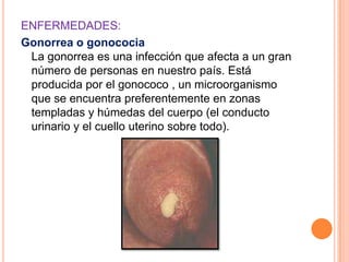 ENFERMEDADES:
Gonorrea o gonococia
 La gonorrea es una infección que afecta a un gran
 número de personas en nuestro país. Está
 producida por el gonococo , un microorganismo
 que se encuentra preferentemente en zonas
 templadas y húmedas del cuerpo (el conducto
 urinario y el cuello uterino sobre todo).
 