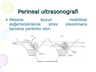 Perineal ultrasonografi Mesane boyun mobilitesi değerlendirilerek stres inkontinans tanısına yardımcı olur.  
