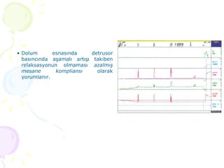 Dolum esnasında detrusor basıncında aşamalı artışı takiben relaksasyonun olmaması  azalmış mesane kompliansı  olarak yorumlanır. 